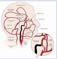 Image result for internal carotid arteries stenosis