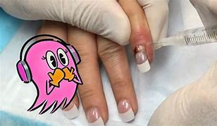 Image result for Bruised Pinky Finger