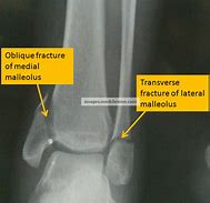 Image result for Medial Malleolus Fracture