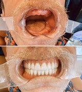 Image result for Fake Teeth That Look Real