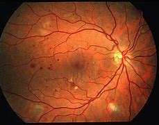 Image result for Diabetic Retinopathy