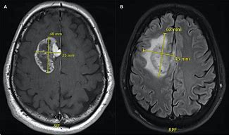 Image result for How Big Is a 10 Cm Tumor