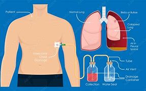 Image result for Chest Tube Drainage System