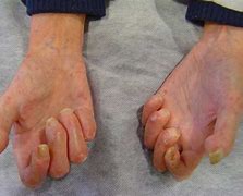 Image result for esclerodermia