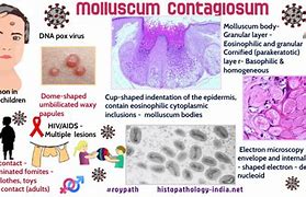 Image result for Pathogenesis of Molluscum Contagiosum