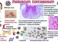 Image result for Molluscum Contagiosum Diagram