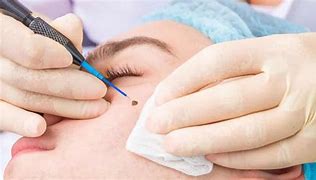 Image result for Treatment for Warts On Face