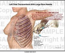 Image result for Needle Thoracentesis