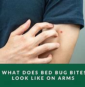 Image result for What Does Bed Bug Bites Look Like On Humans