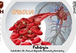 Image result for embolia
