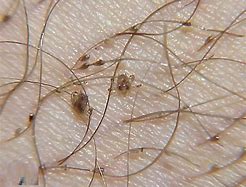 Image result for Crab Lice Symptoms