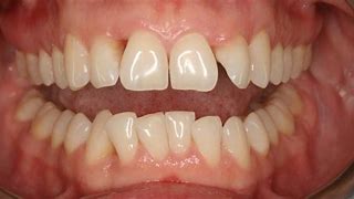 Image result for Aggressive Periodontitis