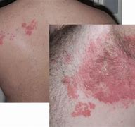 Image result for Skin Eruptions