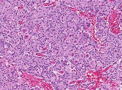 Image result for Neuroendocrine Carcinoid Tumor Pancreas