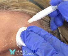 Image result for Keratosis Removal