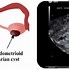 Image result for 11 Cm Cyst On Ovary