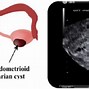Image result for Cyst On Right Ovary