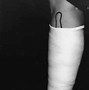 Image result for Short Arm Cast Drawing