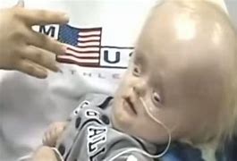 Image result for Baby Boy Born without a Brain