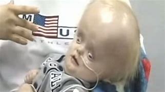 Image result for Kid Born without a Brain