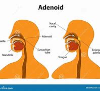 adenoideo 的图像结果