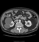 Image result for Hyperdense Renal Cyst