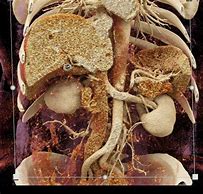 Image result for Kidney Cyst Ultrasound
