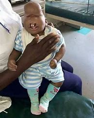 Image result for Baby Born with No Head