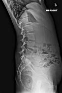 Image result for Pediatric Lumbar Spine