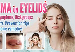 Image result for Papilloma On Eyelid