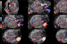 Image result for Dysgerminoma Ultrasound