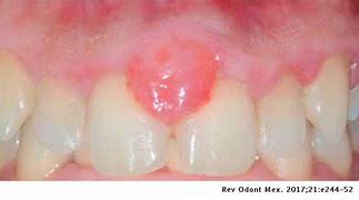 Image result for Gingival Pyogenic Granuloma