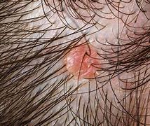 Image result for Skin Tags Back of Head