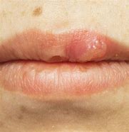 Image result for What Does HIV Mouth Sores Look Like