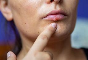 Image result for Labial HPV