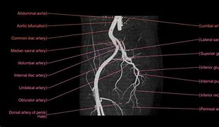 Image result for Lower Limb Angiogram