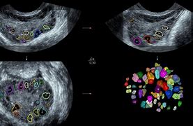 Image result for Polycystic Ovary Morphology