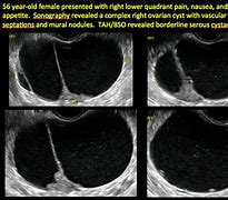 Image result for Serous Cystadenoma Ovary Ultrasound