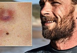 Image result for Skin Cancer From Sun Exposure