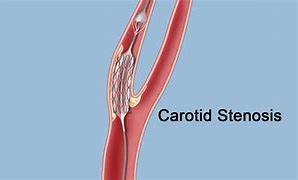 Image result for Carotid Sinus Stenosis