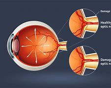 Image result for glaucomatoso