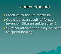 Image result for Jones Fracture