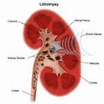 Image result for 3Mm Kidney Stone Actual Size