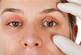 Image result for Red Swollen Eyelid