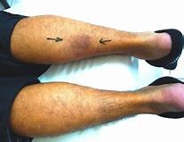 Image result for Torn Calf Muscle