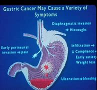 Image result for Bloated Stomach Cancer