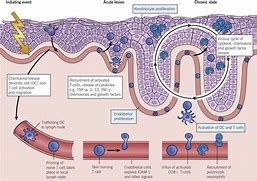 Image result for Psoriasis Biologics