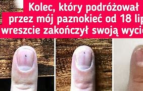 Image result for co_to_znaczy_zespół_obcego_akcentu