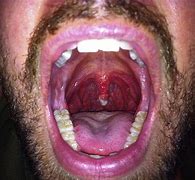 Image result for Growth On Uvula Papilloma