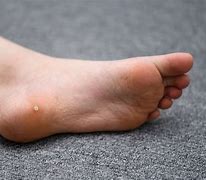 Image result for Wart On Side of Foot